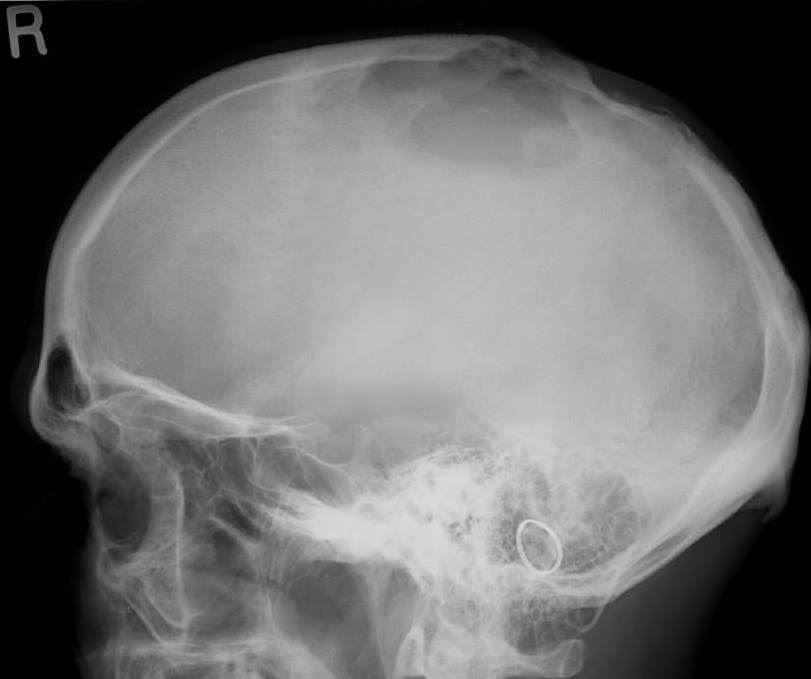 Bone Tumours And Benign Lytic Lesions